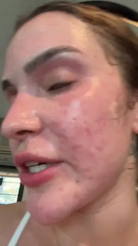 @PeaceOutSkincare patches stick to your face okay like no other #acne #acneskin #beauty 