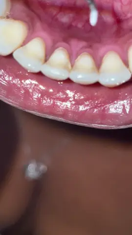Is it normal for hard plaque to build up ? Yes. Do I scrape the buildup hard plaque off my teeth? Yes. Do they do this at least every six months at the dentist? Also yes. Am I going to do it anyway… Yes. 🤷🏽‍♀️ (sound up)  I do not suggest You try this at home, but be very careful not to poke your gums! #tee#teethr#hardplaqent#dentalhygienist