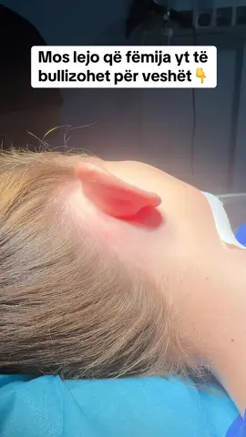 Rimodelimi i veshëve fillon nga 5vjec e lart. Si operacion bëhet me mpirje lokale por te fëmijët nën 10vjeç zakonisht bëhet me totale pasi nuk durojnë dot procesin e mpirjes dhe nuk qëndrojnë pa lëviz. Operacioni zgjat 30min për vesh dhe është i përjetshëm. Proces i sigurtë, jo traumatik, rezulta përjetë, cmim i arsyeshëm për shërbimin dhe cilësinë që merr🔥🔥🔥#rinoplasticatirana 