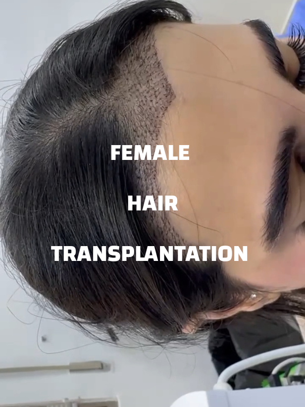 زراعة الشعر لإعادة تشكيل و تصميم مقدمة الشعر عند الإناث #اميمة_الطبي #hairtransformation  #زراعة_الشعر  #زراعة_الشعر_في_الاردن #hairtransplant @Dr suhaib  د صهيب الصمادي 