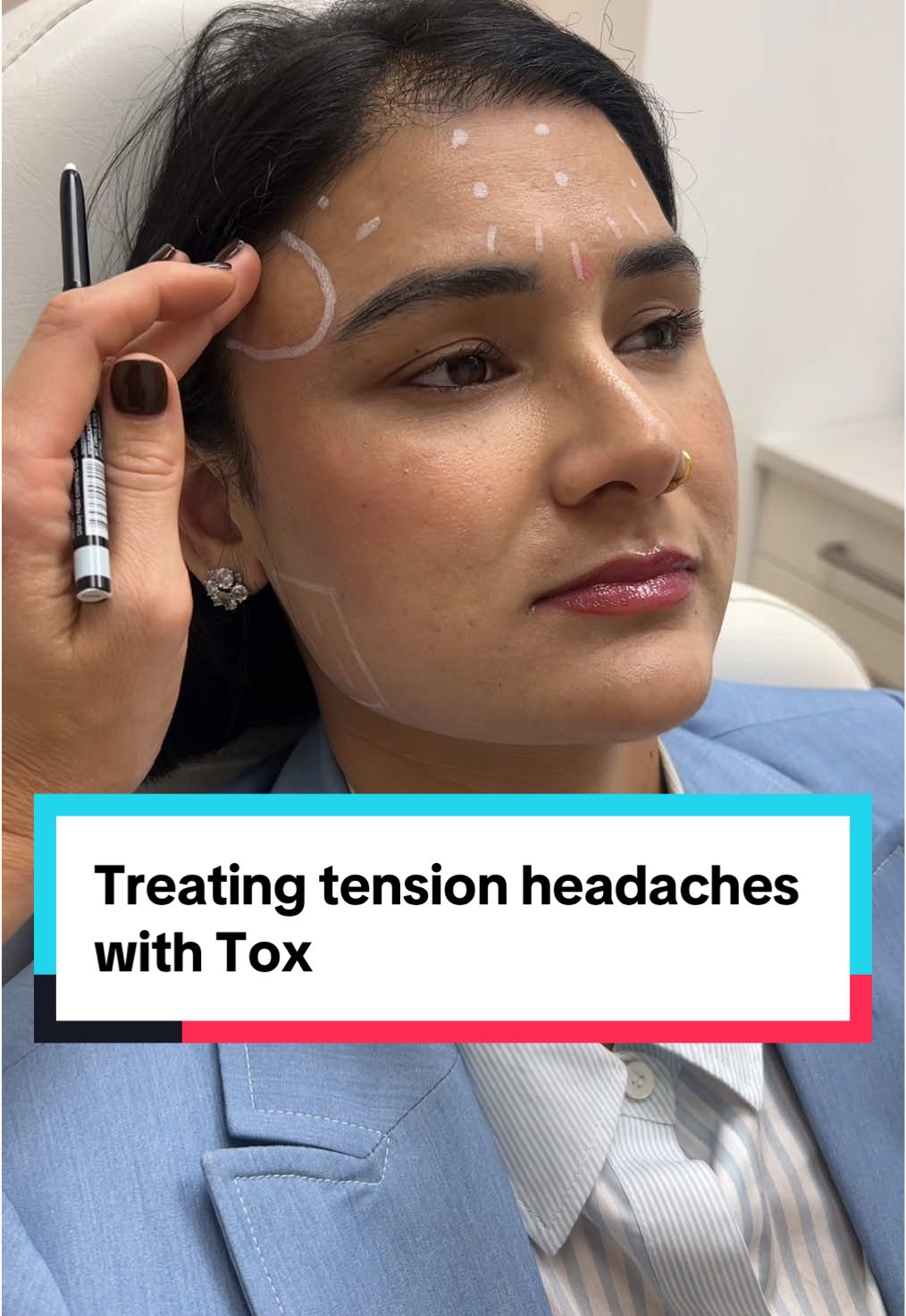 Temporalis treatment is just as important as the masseter at reducing tension! I expect her to have full relief and softened features 🥰😌 #educational #asmr #unintentionalasmr #soothingvoice #calming #aestheticinjector #chicagoinjector #fnp #chicago #chicagoinfluencer #relaxs 