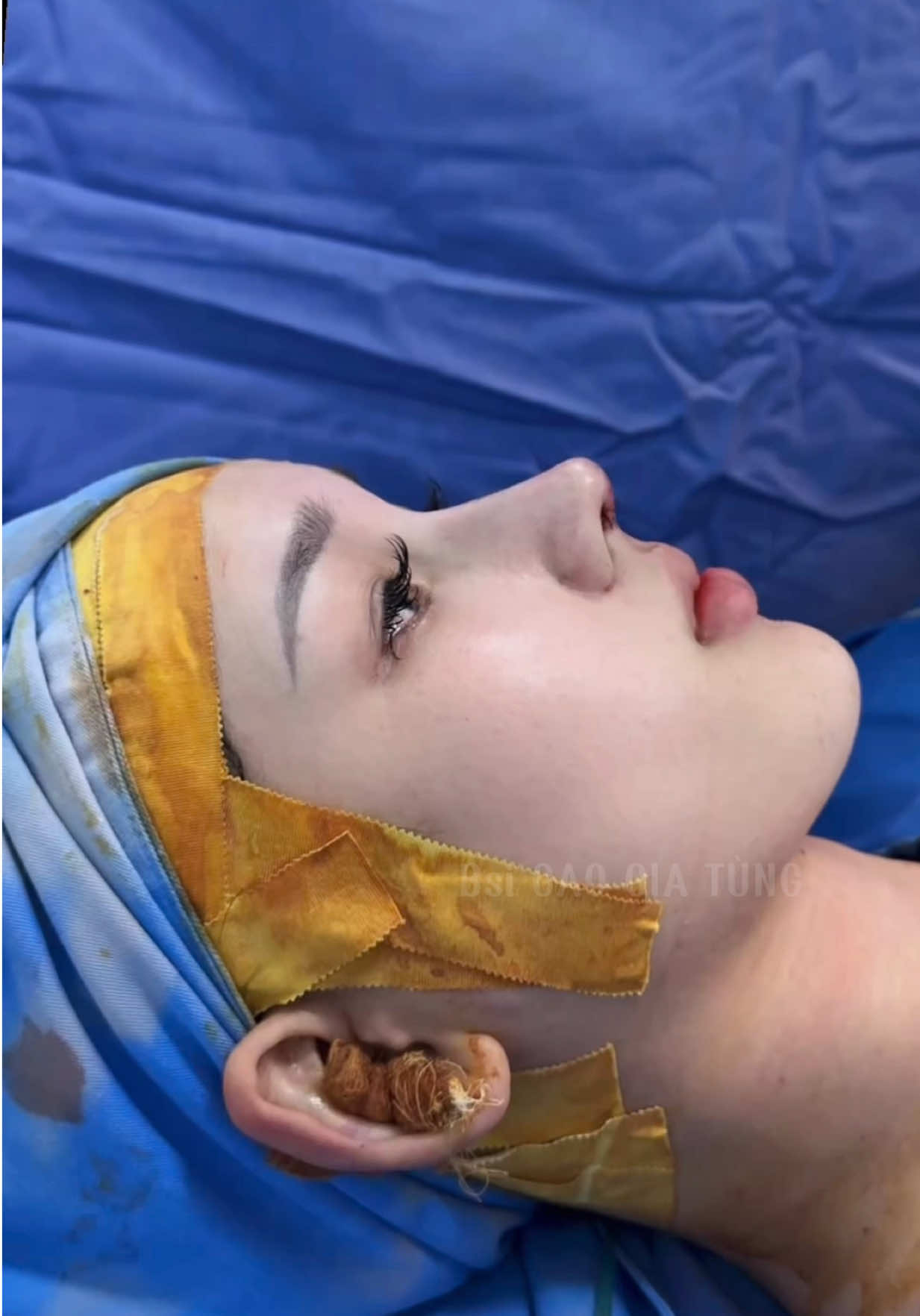 Mũi cũ tràn bè do tiêm filler sóng mũi gồ cao . Sửa lại dánh Mũi Trung Hoa hiện đại - Sang Trọng #muitrunghoa #suamuihong #xuhuong #nangmui #muicautruc 