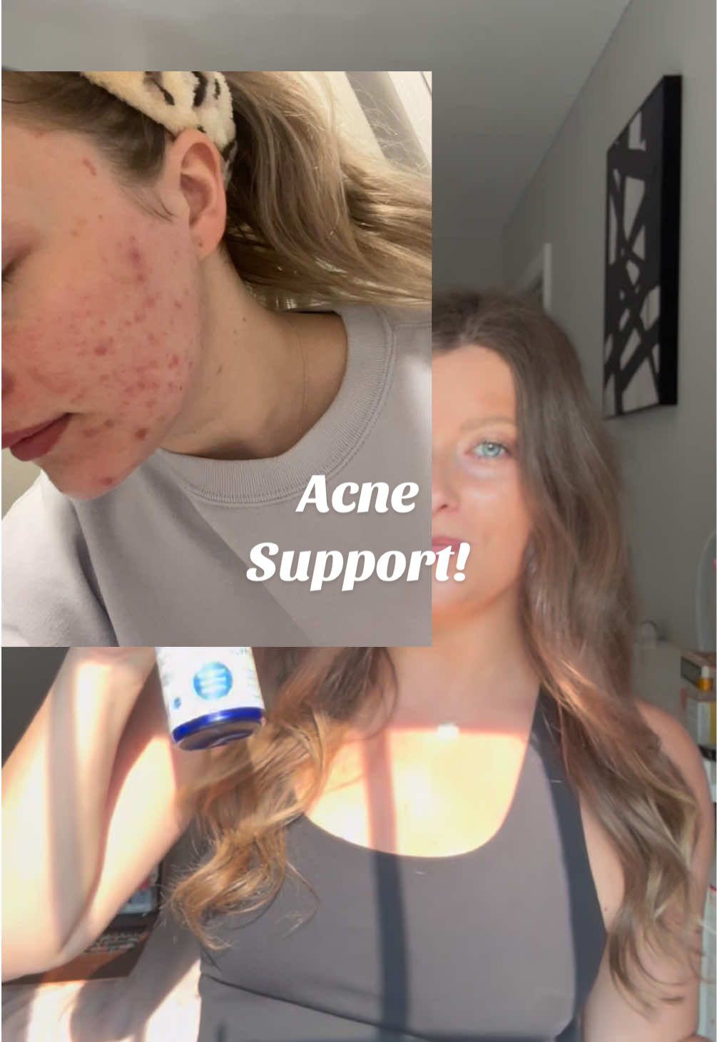 Acne Support!  #wellness #wellnesstips #acne #acneproneskin #SelfCare  