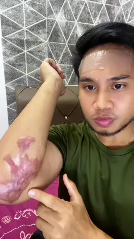 #scarsheet #acnepatch #keloidremoval #scarremoval #parutjerawat 