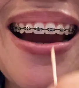 I hate my little triangles. I always think it’s a pepper or food stuck in my dang teeth 🙄😭