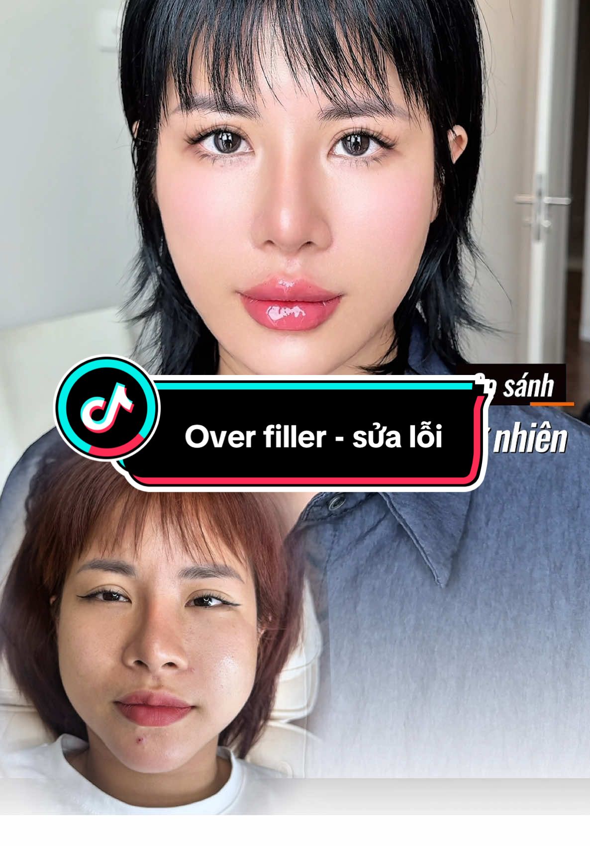 Quá sợ hãi với 13cc cho 2 bên má, vị khách này đã qua Bs Linh tiêm tan và cân chỉnh lại toàn bộ gương mặt , cùng xem kết quả nhé  #drphamhailinh #tiemfiiler #bacsitiemmoidep #overfiller #bienchung 