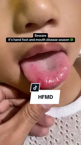 If your child experiences similar symptoms, please get them checked immediately and keep them home to prevent spread of the virus 🦠 #handfootandmouthdisease #hfmdisease #hfmdawareness #fyp 