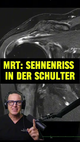 Eine Ruptur der Supraspinatussehne ist kein Notfall. Aber sie ist auch kein Zufallsbefund, den man ignorieren sollte. Viele Patient:innen erhalten nach einem MRT die Diagnose: „Sehne gerissen – Sie brauchen eine OP.“ Aber was sagt die Wissenschaft? 🔍 Fakten statt Panik In der Altersgruppe über 50 zeigen mehr als 40 % aller Menschen asymptomatische Risse der Rotatorenmanschette – oft unbemerkt, ohne funktionelle Einschränkung. Ein Riss auf dem Bild ist also nicht automatisch behandlungsbedürftig. 🧠 Entscheidend ist nicht das Bild, sondern die Funktion. Wenn der Arm aktiv über 90 Grad gehoben werden kann, keine wesentliche Kraft fehlt und der Schmerz durch gezieltes Training reduziert werden kann, ist keine sofortige Operation notwendig. 📉 Was bringt die OP wirklich? Randomisierte Studien zeigen: Bei degenerativen Teilrupturen bringt ein konservativer Ansatz (Physiotherapie + Kräftigung) ähnliche Ergebnisse wie eine Operation – bei weniger Risiken, kürzerer Ausfallzeit und geringeren Kosten. ⚠️ Aber Achtung: Akute traumatische Risse bei jungen Menschen mit plötzlichem Kraftverlust: OP frühzeitig erwägen. Massive Rupturen mit „Pseudoparalyse“: Hier reicht konservative Therapie meist nicht mehr aus. Chronische Risse mit Retraktion und Fettinfiltration: OP-Erfolg fraglich – hier ist realistische Aufklärung wichtiger als OP-Versprechen. 💬 Fazit: Nicht jede Sehnenruptur ist ein Grund zur Operation. Aber jede Ruptur ist ein Anlass zur genauen klinischen Untersuchung, differenzierten Indikationsstellung und ehrlichen Aufklärung. Denn nicht das Bild entscheidet, sondern der Mensch.