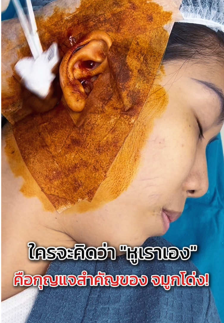 หูของเราคือกุญแจสำคัญในการทำให้จมูกโ่ด่ง ! #dscclinic #กระแสมาแรง #เสริมจมูก #รีวิวศัลยกรรม #รองปลายกระดูกอ่อนหลังหู 