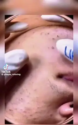 Face clean up crazy pimple popping can’t look away🫠#zit  #zithappens #blackhead #pimples #satisfyingvideos  