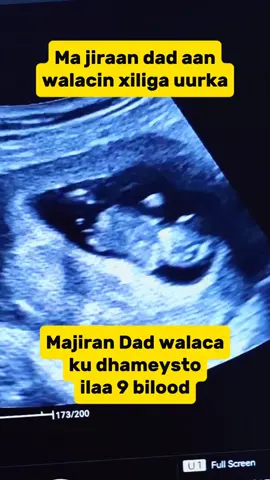 hypermesisgravidarum  #foryour #foryoupage #Fyp #videoviral #cupcut 