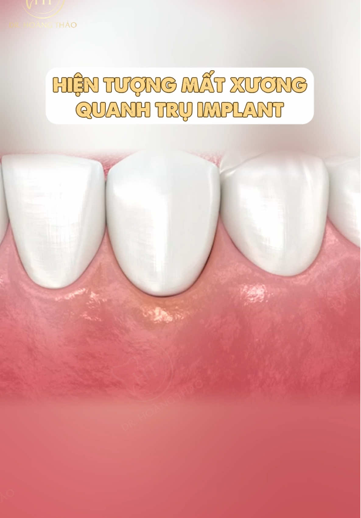 Đừng tưởng cấy implant là xong! Nếu không chăm sóc tốt → nguy cơ viêm quanh implant, tiêu xương, mất răng 🚨#xuhướng #nhasihoangthao #nhakhoauytin #invisalign #implant 