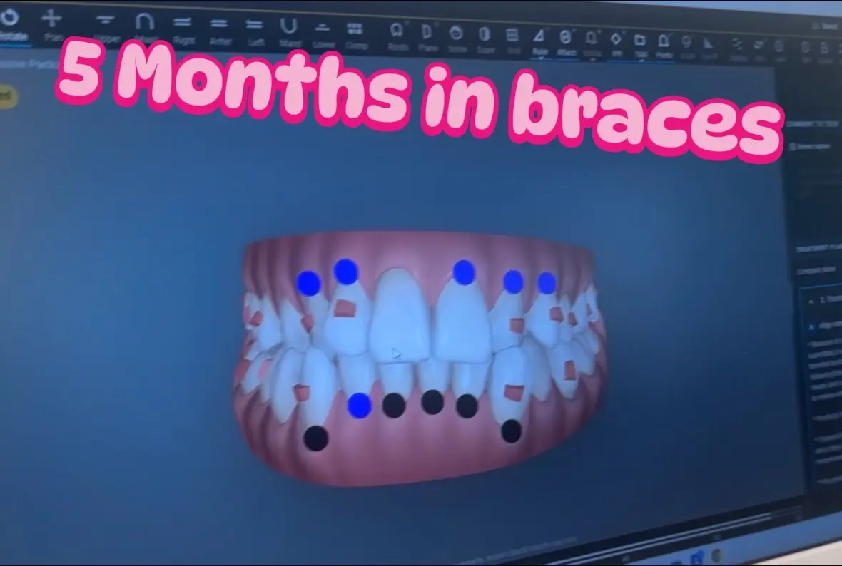 I mainly see the correction in my crossbrite. I was seeing more progress in the beginning now I feel like my teeth haven't changed much for a while. I think they are going to try to have me get teeth pulled due to overcrowding and i really dont want to.🥲 I may see another orthodontist if so😬 #overcrowding #ortho #crossbite #braces 