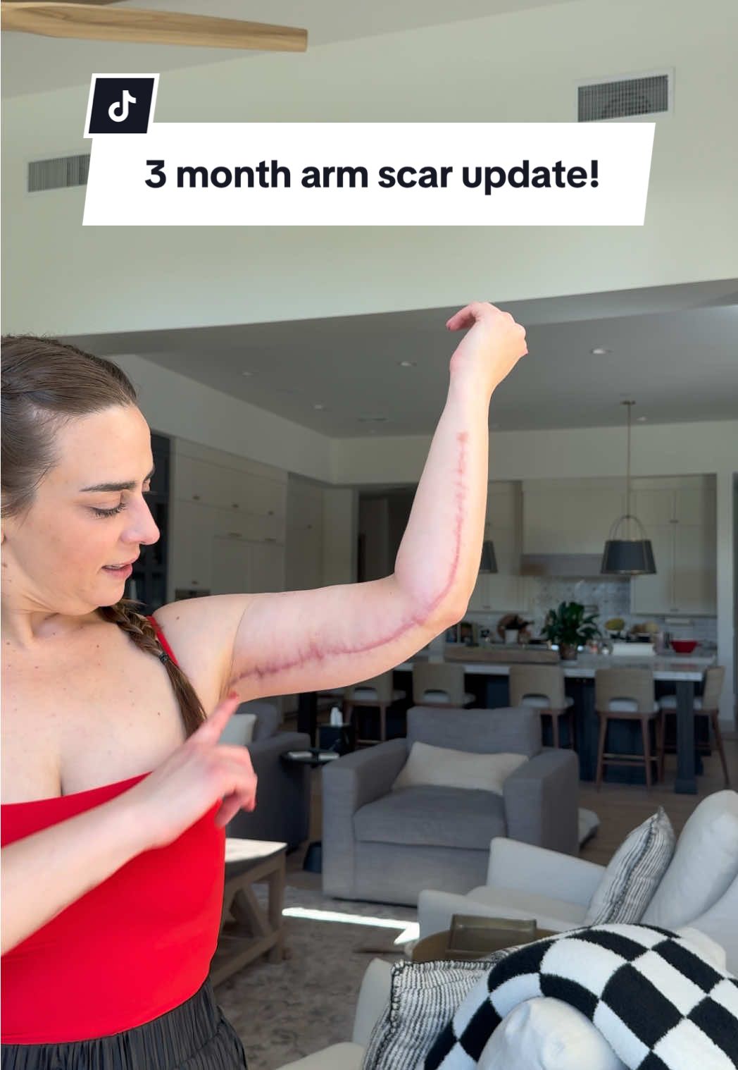I don’t love my scars, but I don’t hate them either. Would I prefer arms without scars? Absolutely. But after living most of my life obese and being left with loose skin, my options were loose skin or scars. And I chose scars. I wear them proudly. Not because I’d rather have scars than no scars, but because I own my decision. My body is the scrapbook of my life. Some choices I’m proud of, some I’m not, but they all tell my story. And it’s one worth telling. 💜 *All surgeries come with risks and everyone has to decide what the best option for them is!