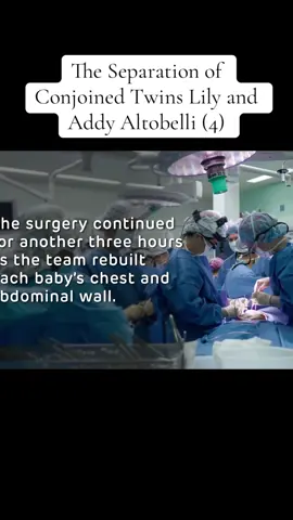 The Separation of Conjoined Twins Lily and Addy Altobelli (4)