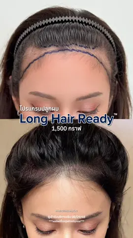 ล้านแค่ไหนก็คุมได้ค่ะ! 😍✨ #รีวิวปลูกผมHairClinique #HairCliniquebySLC #BeYourBestSelf