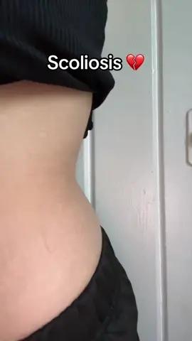 Scoliosis check ☑ #scoliosis  #fyppp #hips 