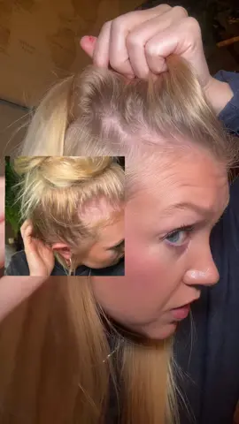 Force factor hair growth accelerator has truly worked for me and my postpartum, bald spots! I no longer have bald spots on either side of my hair fine and my hair is coming back thicker and fuller!! if you want hair growth or hair regrowth get the force factor hair growth accelerator!! Lustriva is a powerful ingredient that is more superior than biotin. Talk to your doctor and see if this is right for you. Results may vary. These are my personal results.  #forcefactor #forcefactorpartner #hairgrowth #postpartumhairloss 