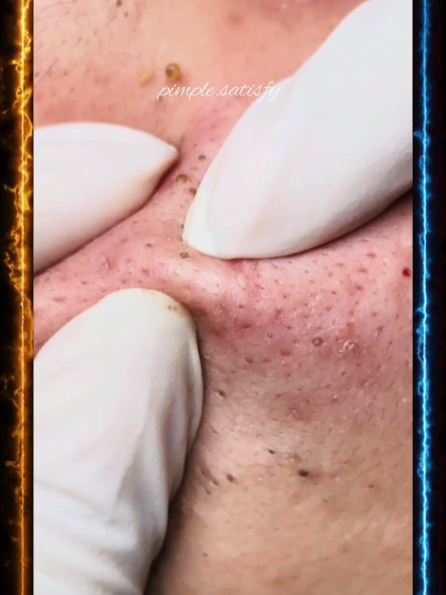 Tips to Prevent Blackheads 1️⃣ Wash your face twice a day with a gentle cleanser. 2️⃣ Exfoliate 1–2 times a week to remove dead skin. 3️⃣ Use products with salicylic acid to clear pores. 4️⃣ Avoid touching your face to reduce bacteria transfer. 5️⃣ Keep your skin hydrated with a lightweight moisturizer. 6️⃣ Always remove makeup before going to bed. 7️⃣ Protect your skin with an oil-free sunscreen#SkincareRoutine #BeautyTips #ClearSkin #Blackheads 