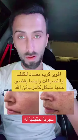 مضاد الكلف والتصبغات