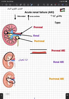 Acute renal failure (AKI) #medicine #medical_student #طب #تمريض #AKI 