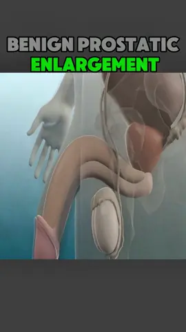 #enlargedprostate #bph #benignprostatichyperplasia #benignprostatichyperplasiatreatment #prostateenlargement #prostatecancer #medical3danimation #3dmedicalanimation