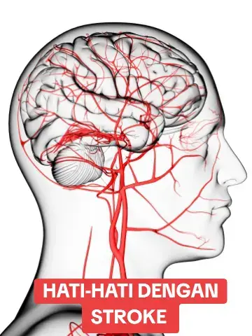 Jika ada di antara keluarga kita yang terkena stroke, jangan panik. Itu kuncinya. Sebab, jika anda panik, justru akan memburukkan lagi stroke yang dialaminya. Ada 1st aid (langkah pertama) dijamin sangat berkesan. Cara ini sudah diperkenalkan secara meluas, agar menjadi pertimbangan masyarakat sebagai alternatif pertolongan pertama bagi orang yang terkena stroke. Cara ini merupakan kaedah penyembuhan melalui 