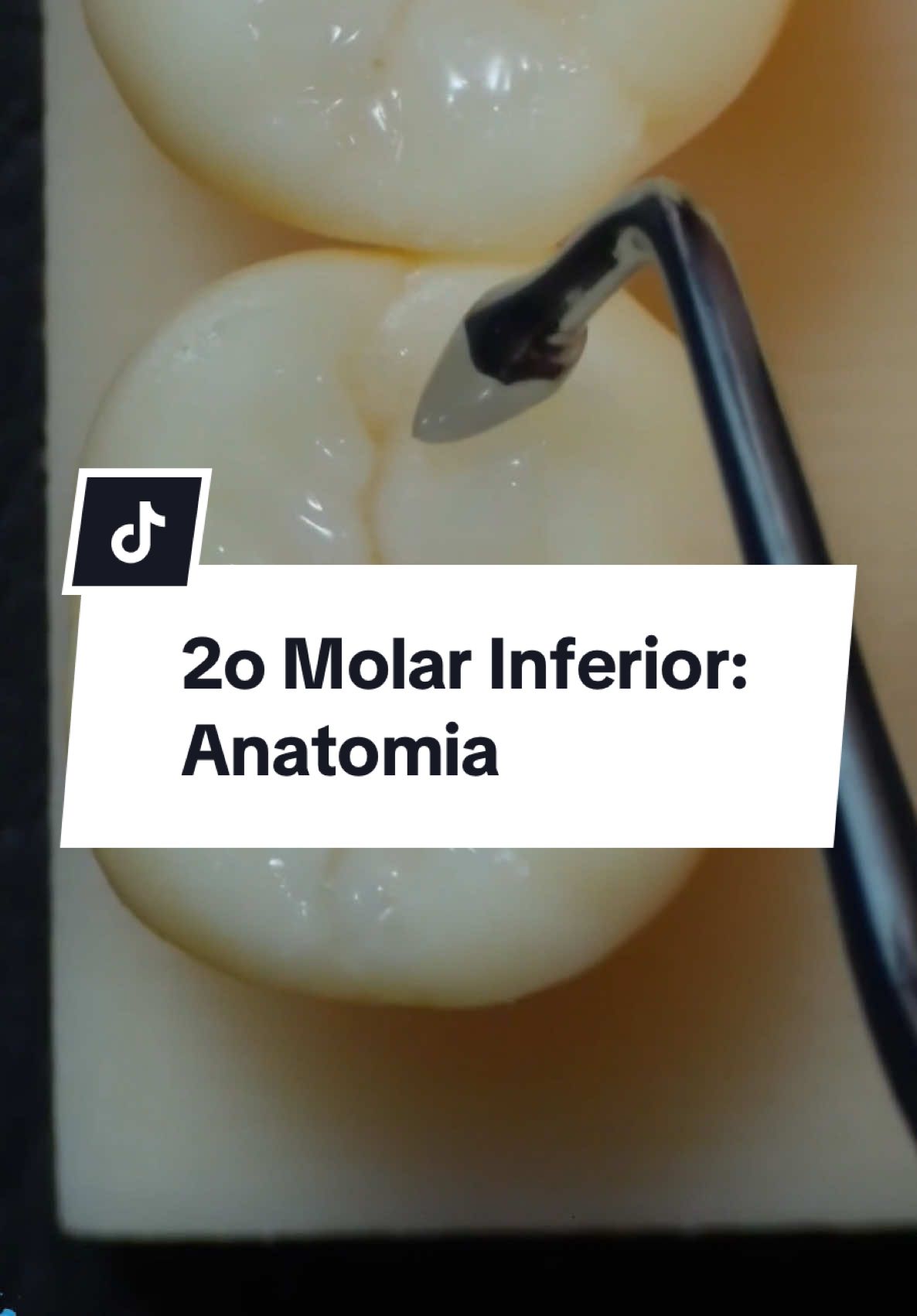 2o Molar Inferior. A anatomia queridinha de todo dentista. #dentista #odontologia #dentistry 