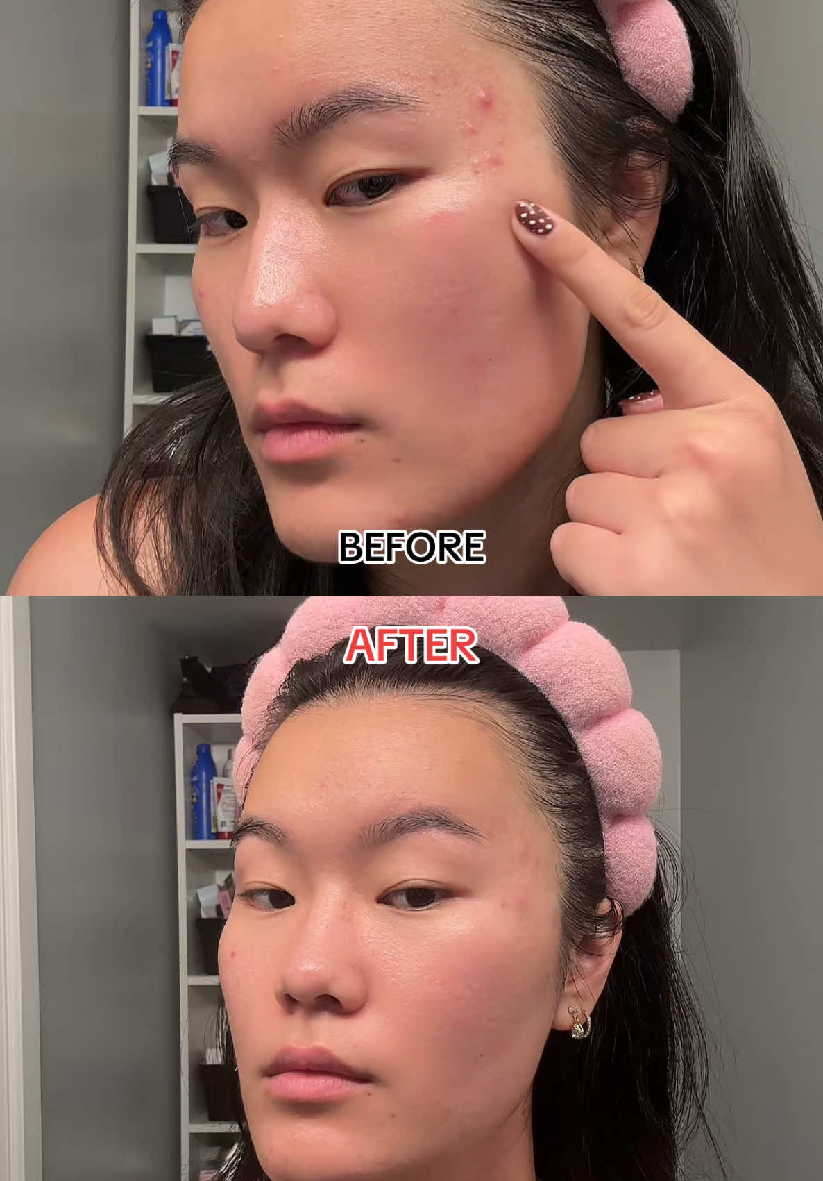 #bringgreen #kbeauty #zincteca #acne #amazon @bringgreen_official 