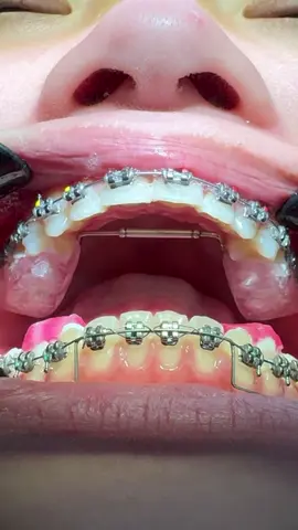 HOT! TL Dental Group 𝐒𝐚𝐥𝐞  MC KL Headway 350.000 ➡️ 𝟏𝟗𝟎.𝟎𝟎𝟎 Link nhóm: https://zalo.me/g/gaccuq876 Tham gia để săn được các khuyến mãi tốt nhất #xuhuong  #tldentalgroup  #chỉnhnha  #hocchinhnha  #niềngrăngmắccài 
