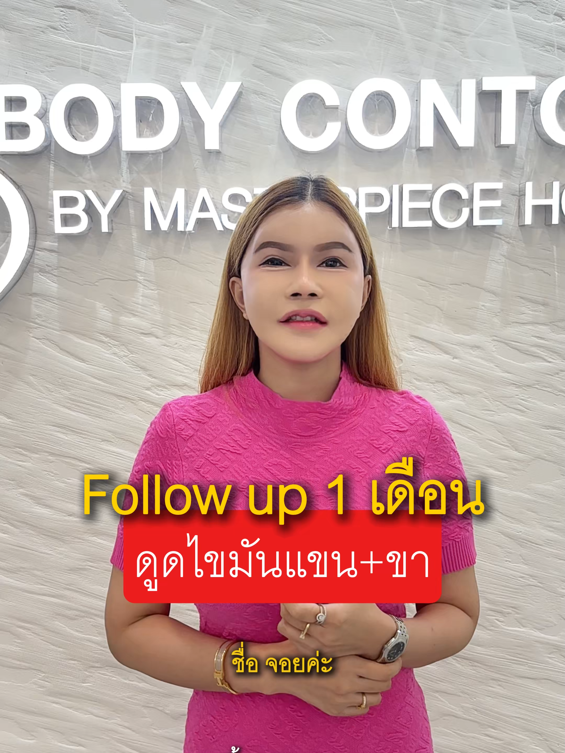Fu 1 เดือน กับเคสลูกสาวหมอกาย โปรแกรมดูดไขมันแขน+ขา #liposuction #masterpiecehospital #ลูกสาวหมอกาย #ดูดไขมันแขน #ดูดไขมันขา