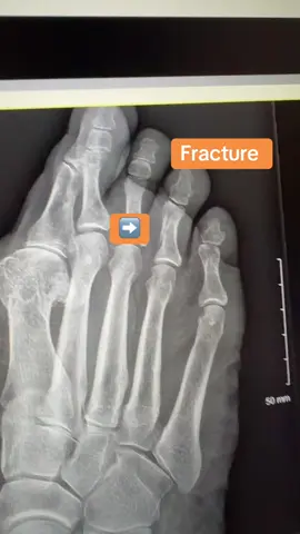 Toe fractures hurt! #xray #toe #fracture #foot #podiatrist 👩🏻‍⚕️🦶🏼🦴🩻