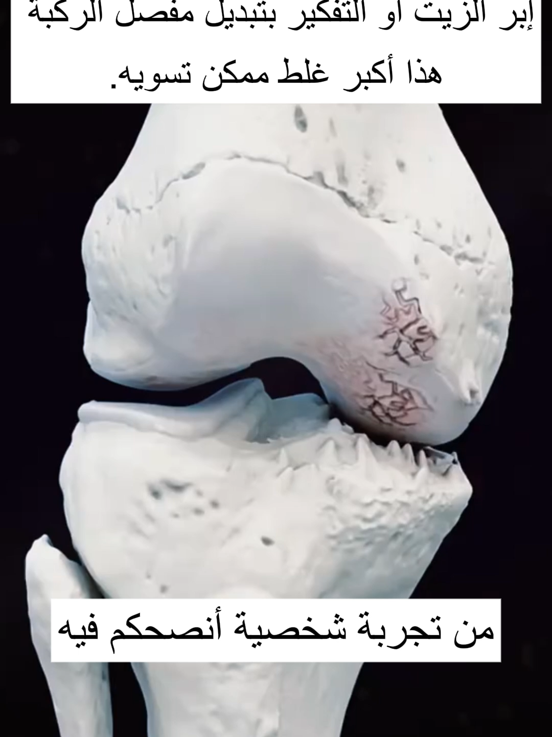 #saudiarabia🇸🇦 #foryoupage #خشونة_الركبة #خشونة_مفاصل_الركبة #خشونة #الروماتيزم  الدهان المعجزة ألي أنهى معاناتي مع خشونة الركبة#المفاصل #مفاصل_وروماتيزم #المفاصل_و_العظام #مفاصل_وجع_التهاب_عظام_عظم_الم #الشعب_الصيني_ماله_حل😂😂