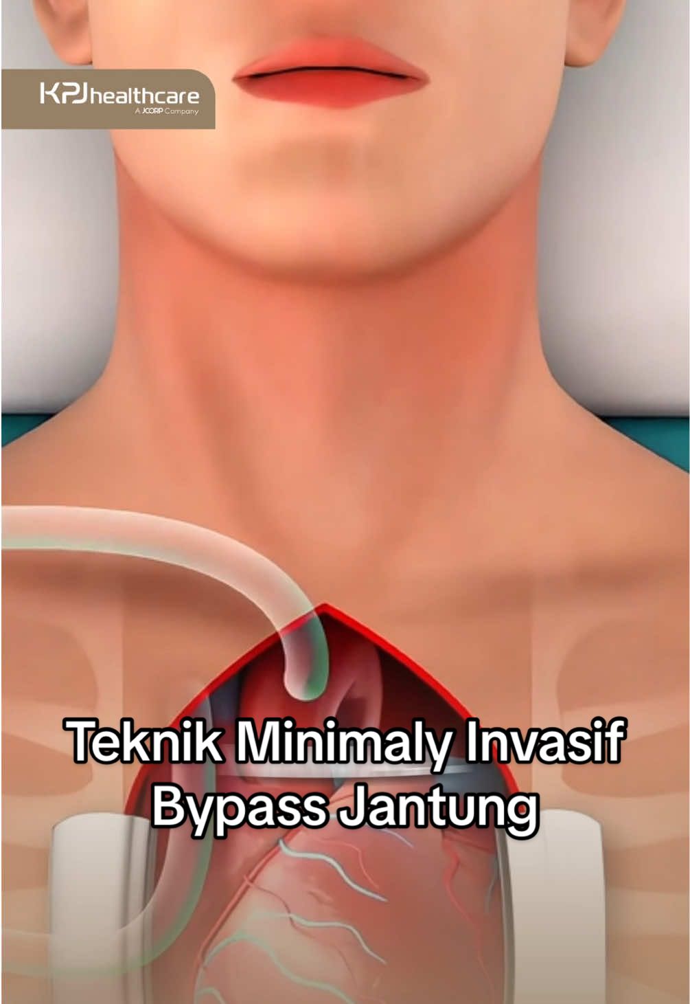 Operasi bypass jantung kini tidak lagi harus melalui sayatan besar di dada. Dengan teknik Minimally Invasive Bypass Surgery, dokter dapat melakukan tindakan melalui sayatan kecil, tanpa harus membelah tulang dada. ✨ Lebih aman ✨ Minim rasa nyeri ✨ Masa pemulihan lebih cepat ✨ Hasil estetika lebih baik Teknologi ini memberi harapan baru bagi pasien penyakit jantung untuk bisa kembali beraktivitas dengan lebih cepat dan nyaman. 💙  #kpj #rumahsakit #malaysia 