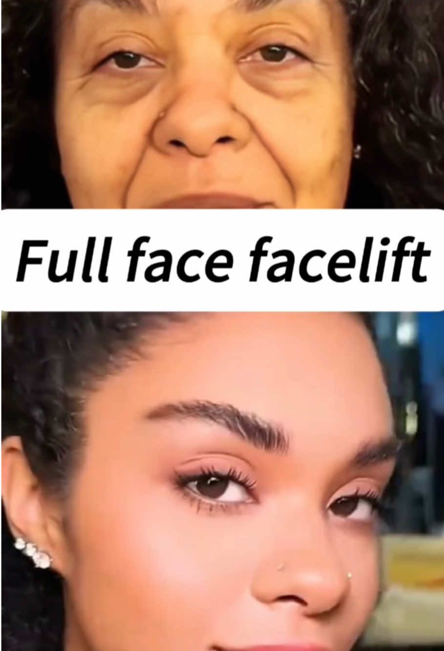 #facelift #Antiaging #FacialAesthetics #Younger 