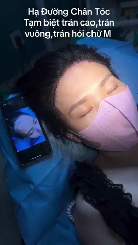 Căng trán hạ đường chân tóc #cangdatran #haduongchantoc #viral #tiktok #pttm 