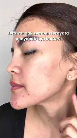 awalnya cuma cobain tapi…beneran bisaa sembuhin jerawat dong  