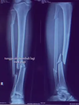 🥀#CapCut #fraktur #frakturtibiafibula #pejuangfraktur #xybca 