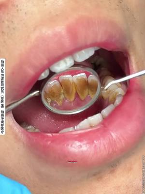 這款牙膏只要用過就會一直回購，bop色修美白牙膏，刷除牙黃牙漬，去黃修白，牙齒越黃越有效果，趕緊來試試