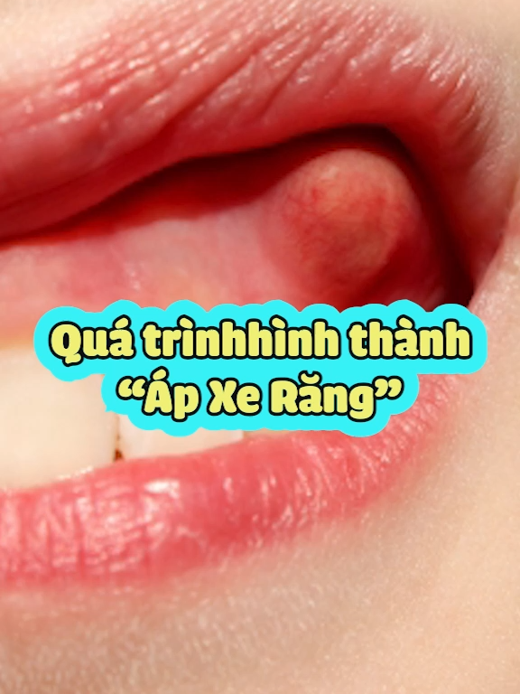 Quá trình hình thành áp xe chân răng #nhakhoa #nhakhoanucuoiduyenbinhduong #apxe #apxerang #saurang #LearnOnTikTok #fyp
