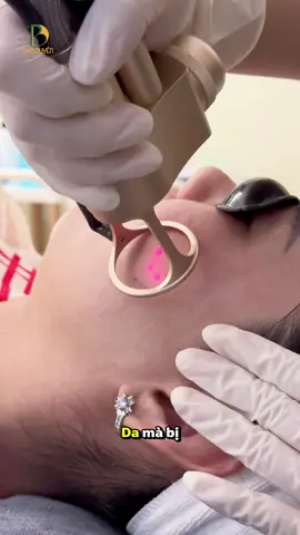 Không phải là “phép màu”, mà là một liệu trình khoa học CO2 Fractional giúp tái tạo bề mặt da vi điểm, hỗ trợ cải thiện sẹo rỗ và làm da săn chắc hơn 💚 Quy trình chuẩn – thiết bị hiện đại – chăm sóc hậu điều trị kỹ lưỡng #PhongKhamDaLieuBaoDuyen #TranMinhDuyen #BaoDuyenClinic 