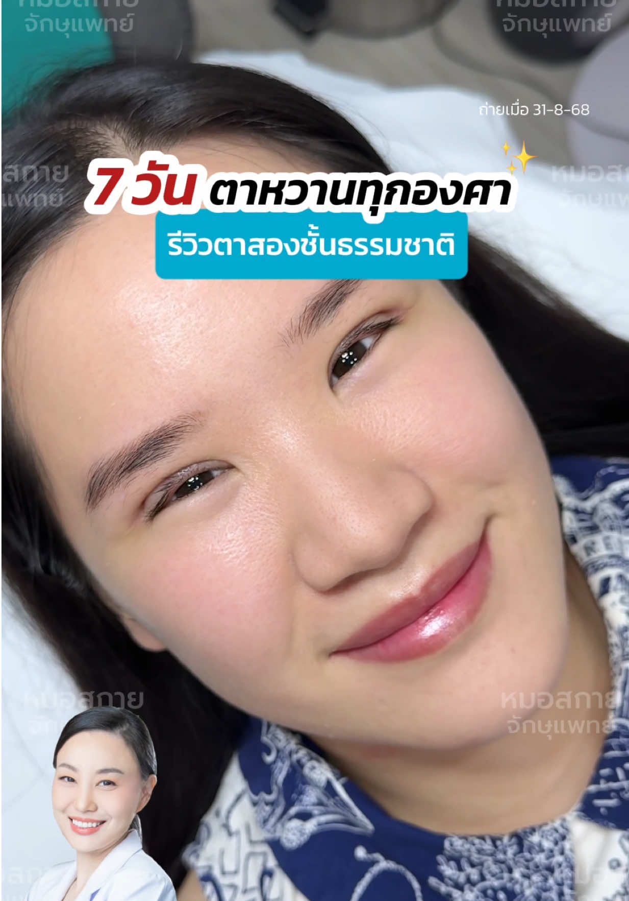 7วัน ตาหวานทุกองศา✨ #รีวิวตาสองชั้น ธรรมชาติ #ทำตาสองชั้น #ไม่มีชั้นตา #หมอสกาย #skyclinic