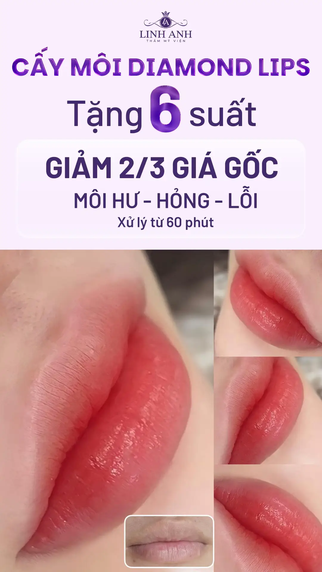 Tặng 6 suất ưu đãi GIẢM 2/3 CHI PHÍ cho chị em đăng ký sở hữu màu môi xinh tại đây #tmvlinhanh #thammylinhanh #phunmoi #phunmoitunhien #caymoidiamondlips 