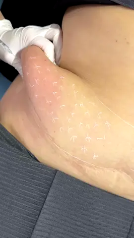 💉💉💉TIÊM TAN MỠ BỤNG 💉💉💉 👉🏻 phá vỡ lớp màng tế bào mỡ, giúp tiêu hủy các mô mỡ và đào thải chúng ra khỏi cơ thể. 👉🏻 Lượng mỡ giảm dần sau khi thực hiện liệu trình đầu tiên. 👉🏻 Đảm bảo các vùng giảm mỡ trở nên thon gọn, săn chắc. 👉🏻 Thời gian thực hiện nhanh chóng  👉🏻 An toàn . Hiệu quả sau liệu trình đầu tiên #tiêmtanmỡbụng Ib trực tiếp mình tư vấn.