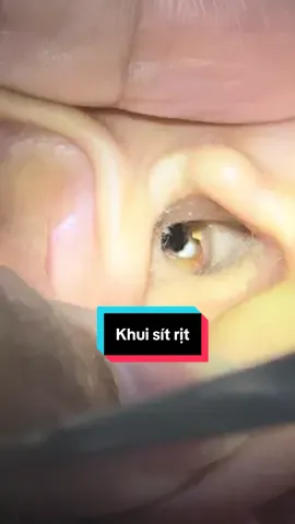 Lấy ráy tai#layraytai #xuhuong #viral 