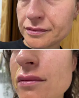 Se acabaron las arrugas de la vejez y de las pipas #trucos #la sustancia #botox casero #principiante