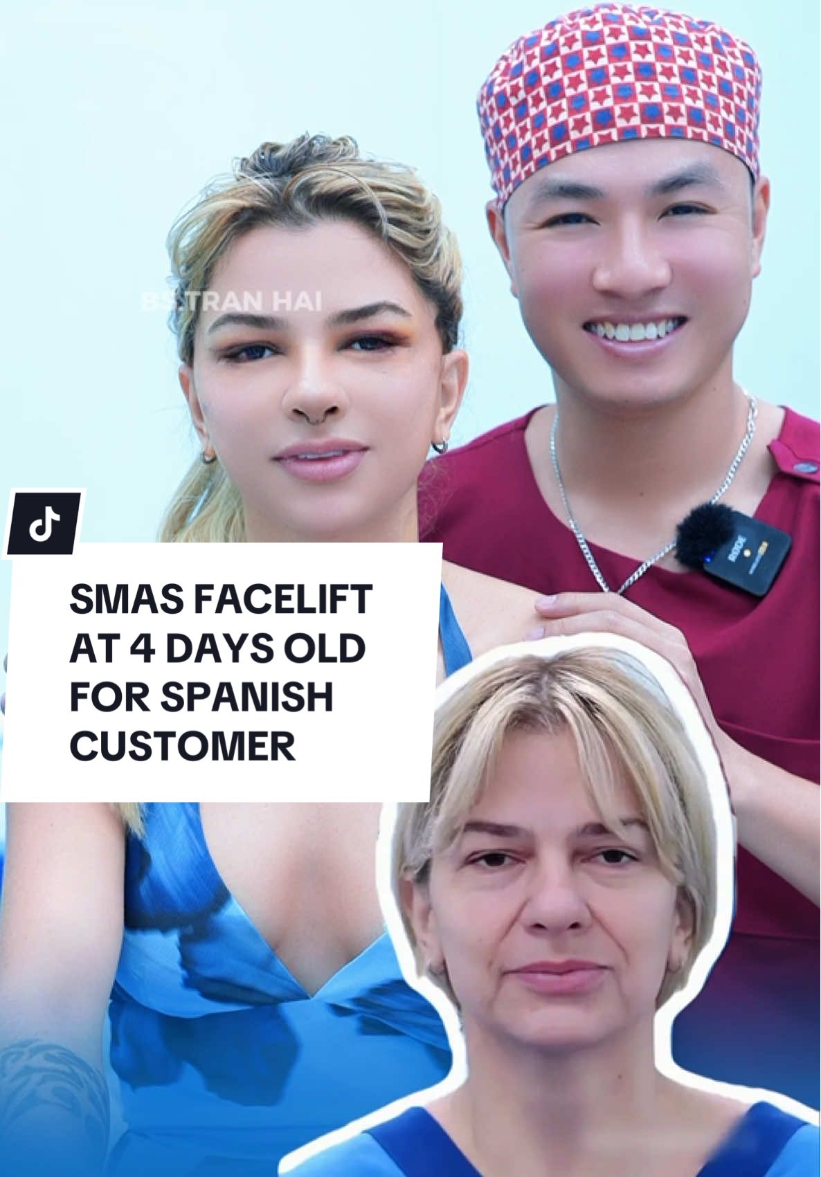 SMAS FACELIFT AT 4 DAYS OLD FOR SPANISH CUSTOMER #facelift #facelifting #xuhuong #xuhuongtiktok #spain 