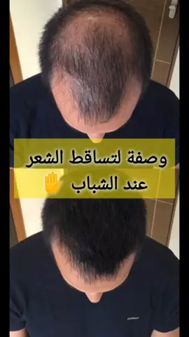 وصفة لتساقط الشعر للشباب ✅ Recette contre la perte de cheveux pour les jeunes hommes ✅ #explore #foryoupage❤️❤️ #fyp #tiktokviral #viral @صحة في دقيقة 