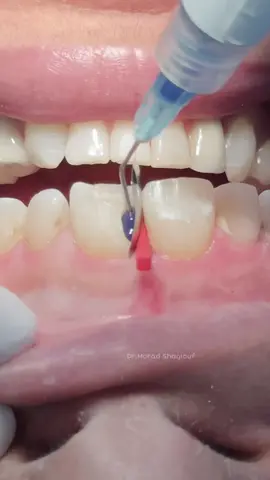 Composite restoration for anterior central incisor tooth 🦷 #dentist #UK 
