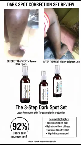 #skinwi #darkspots #viralvideotiktok #Ai dark spots on leg treatment dark spots on leg removal dark spots on legs dark spots on leg results dark spots on leg before after dark spots on leg treatment in nigeria dark spots on leg remedy dark spots on leg cream dark spots on leg recommendation dark knuckles treatment dark knuckles dark knuckles on hands dark knuckles removal cream dark knuckle removal dark knuckles cream dark knuckle whitening serum dark knuckles whitening dark knuckles gummies dark knuckles black skin dark feet treatment dark feet dark feet hyperpigmentation dark feet knuckles dark feet removal dark feet whitening dark feet cream how to lighten dark feet dark feet and hands dark feet remedy at home